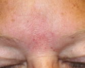 Feel Beautiful - Gel Filler (Restylane Fine Line) into brow creases - After Photo
